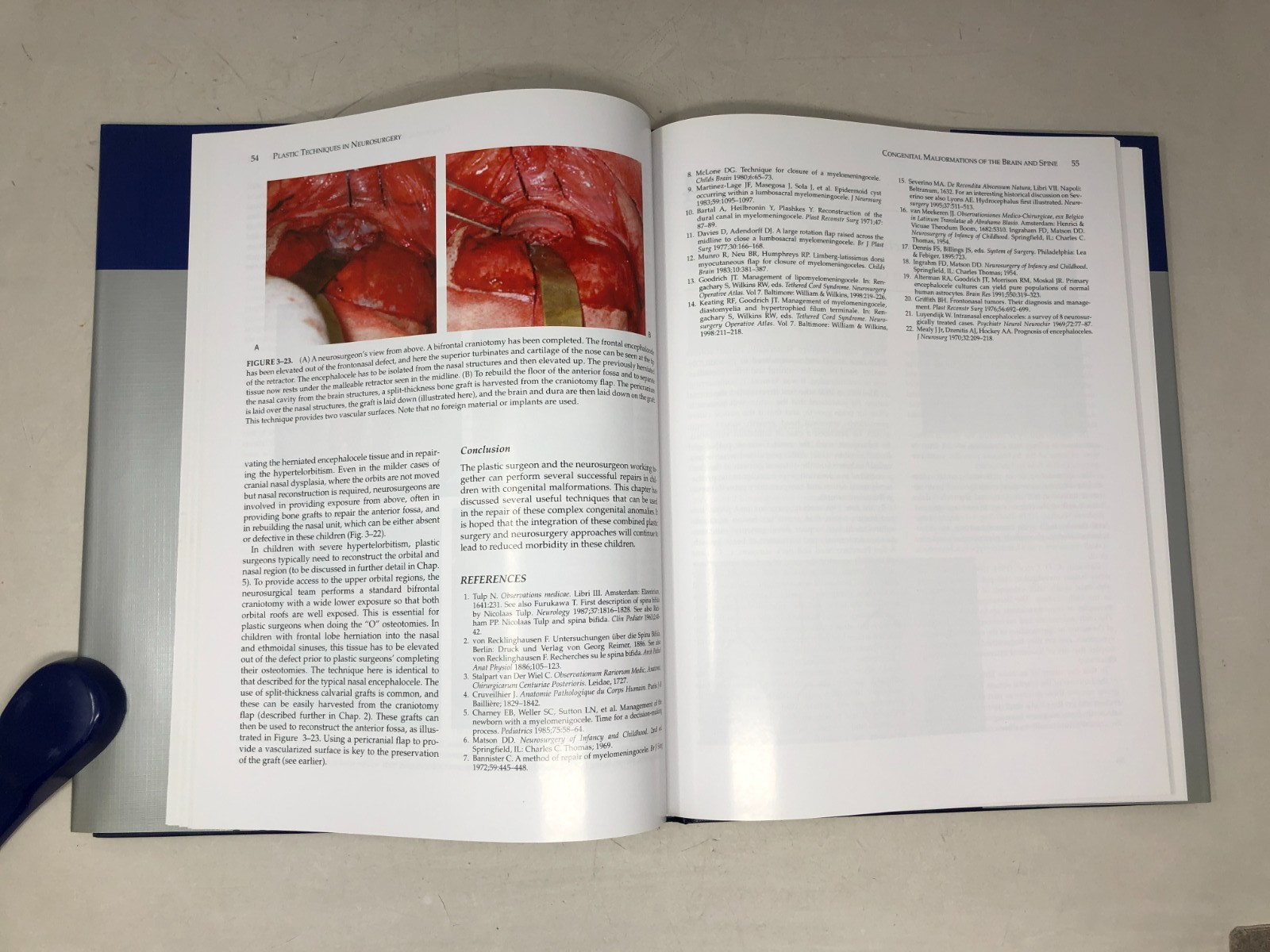 Plastic Techniques in Neurosurgery, 2004, E-122