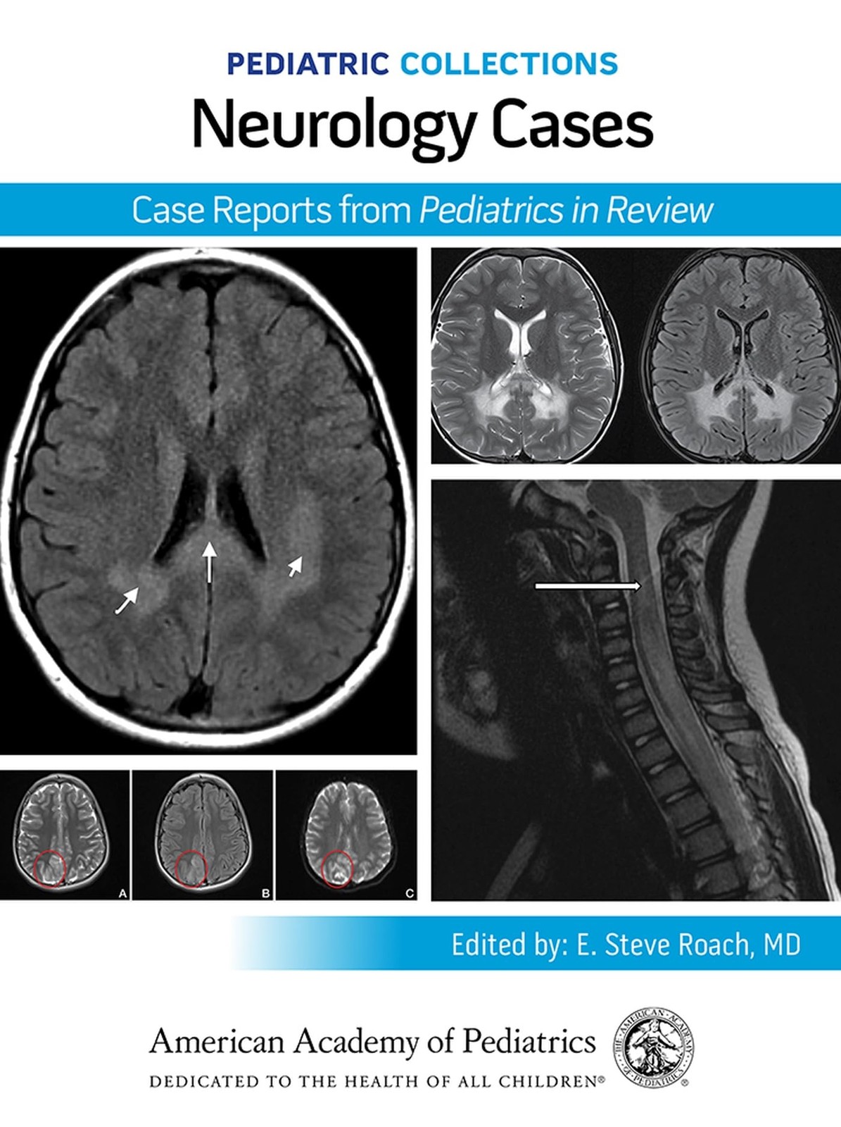 PEDIATRIC COLLECTIONS: NEUROLOGY CASES: CASE REPORTS FROM PEDIATRICS IN REVIEW