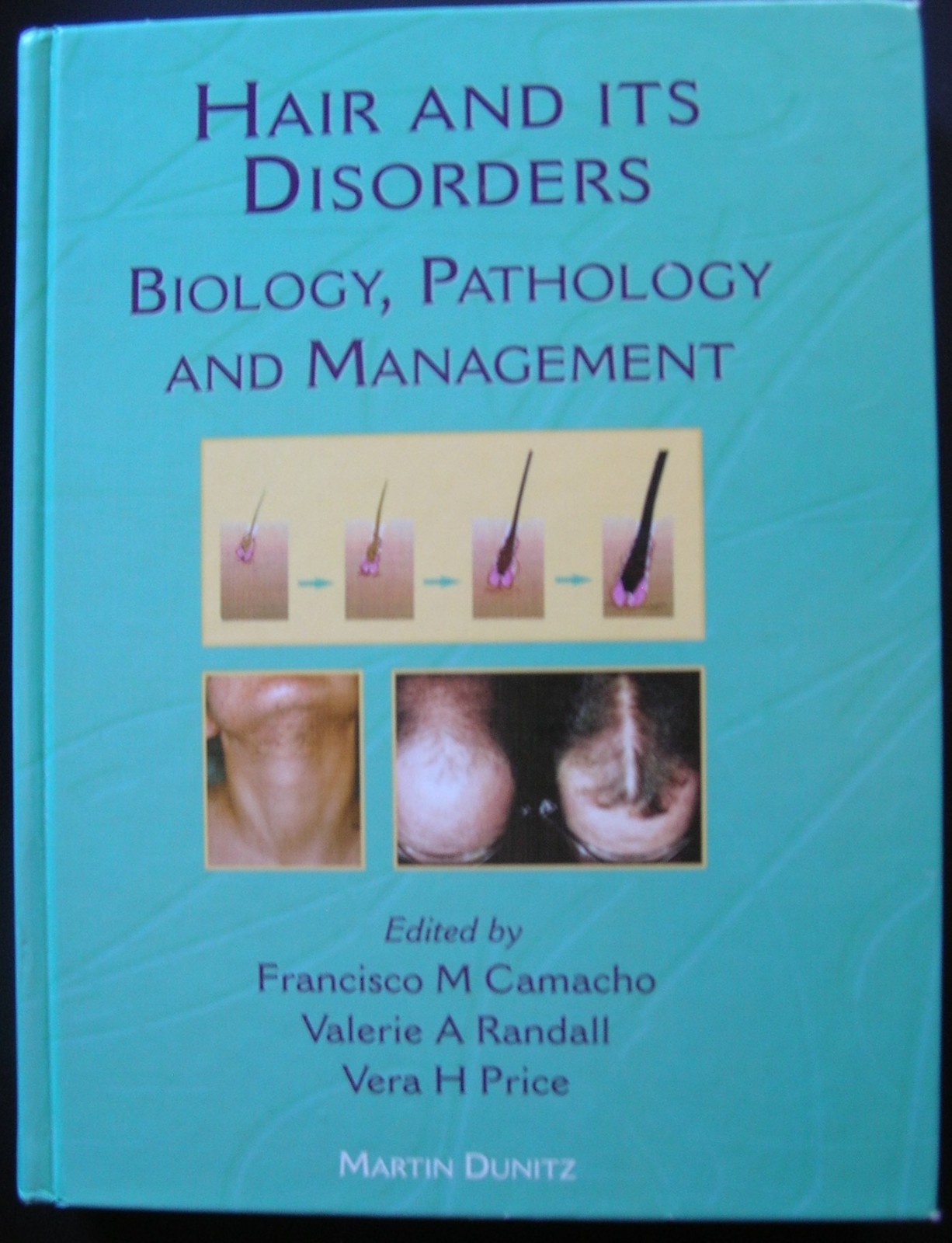 Hair and Its Disorders: Biology, Pathology and Management